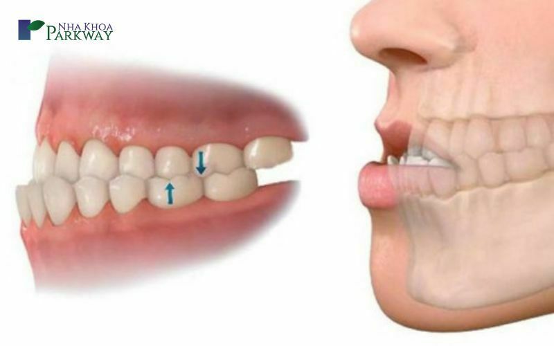 Răng móm do răng sai lệch