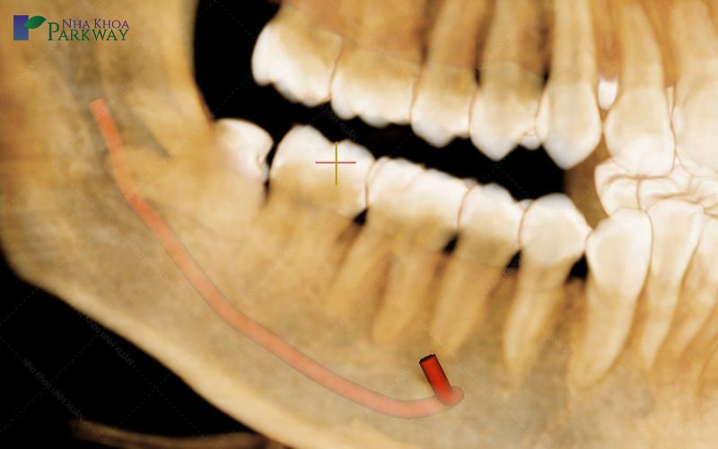 Biến chứng do răng bị sâu lỗ to gây ra