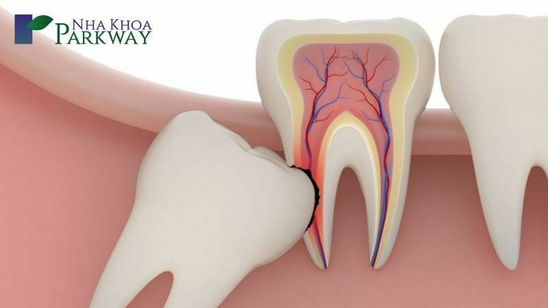 Có nên nhổ răng số 8 không?