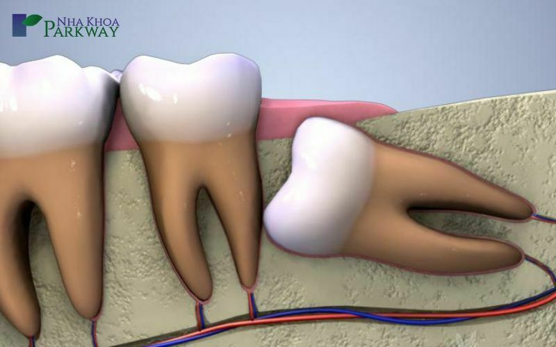 Nhổ răng số 8 mọc lệch có nguy hiểm không?