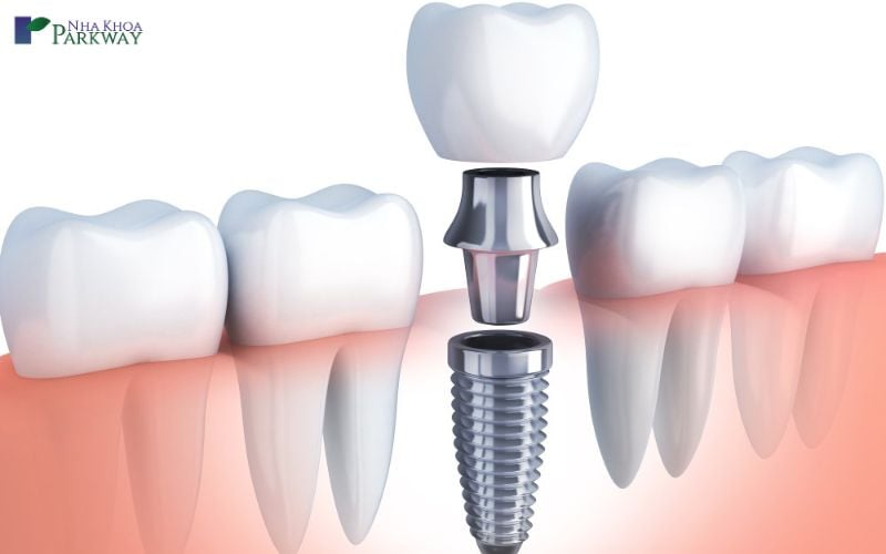 Trồng implant răng kiểu con thỏ tại cơ sở nha khoa uy tín, chất lượng để đảm bảo được độ bền cũng như tính thẩm mỹ của răng, phù hợp với khuôn mặt