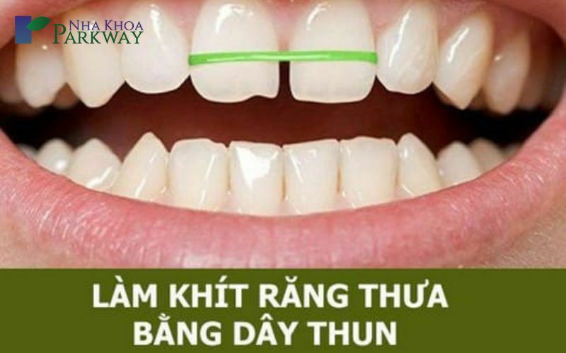 Cách trị răng bị thưa tại nhà