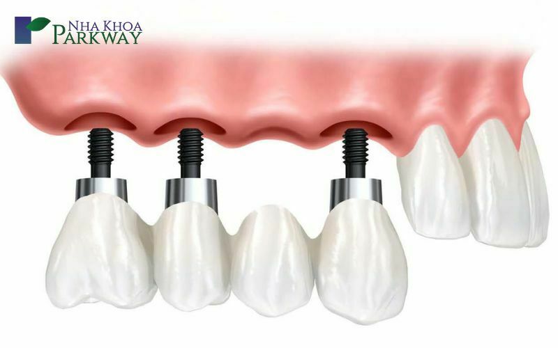 Làm đẹp răng thưa bằng phương pháp cấy ghép implant, làm cầu răng và làm răng giả