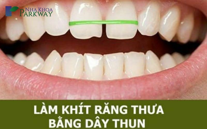 Cách làm răng hết thưa tại nhà bằng dây thun