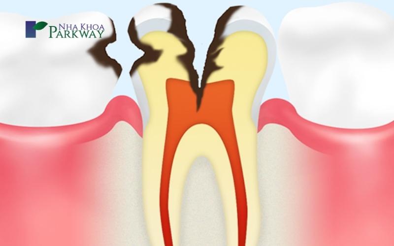 Những nguy hiểm thường gặp ở răng tiền hàm