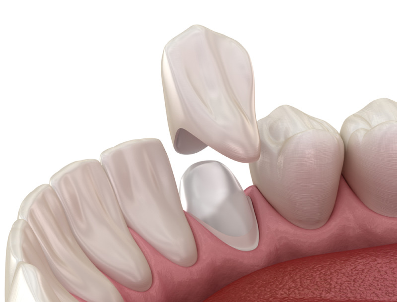 tác hại của việc trồng răng sứ có ảnh hưởng gì không