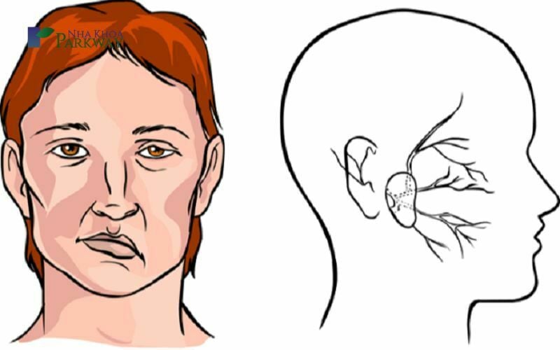 Tại sao mặt bị lệch