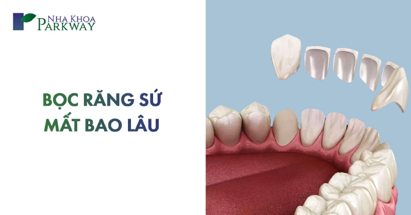 thời gian bọc răng sứ mất bao lâu