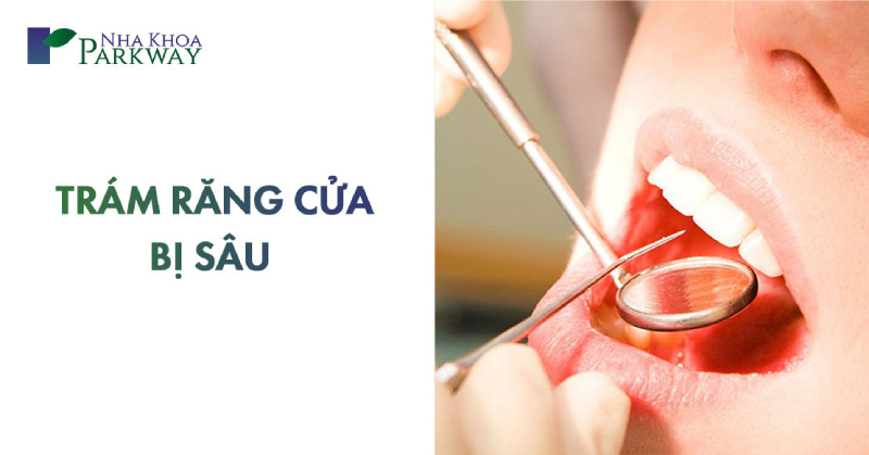 trám răng cửa bị sâu bao nhiêu tiền