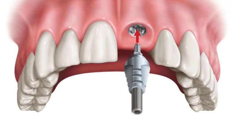 Trồng răng cửa giả cách nào tốt nhất?