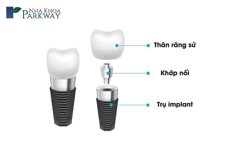 Vì sao nên trồng răng giả cố định?