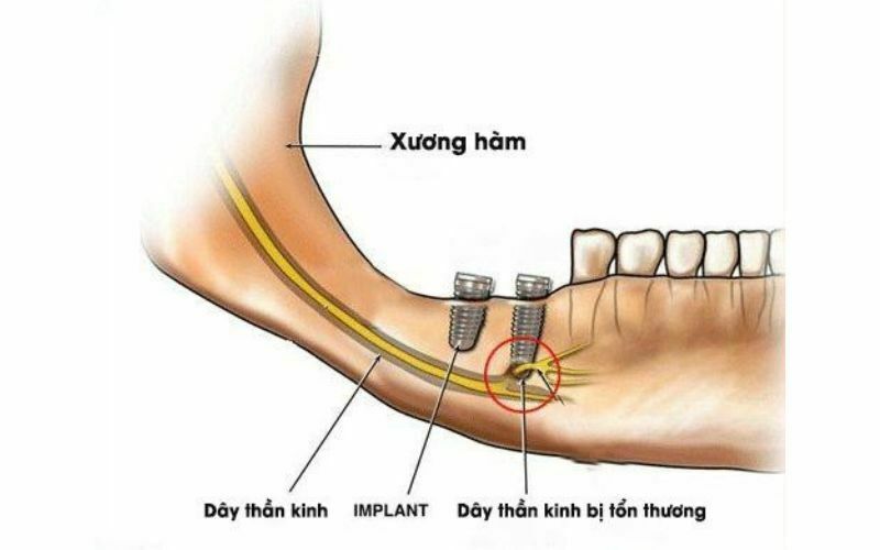 Trồng răng giả giá rẻ có nguy hiểm không?