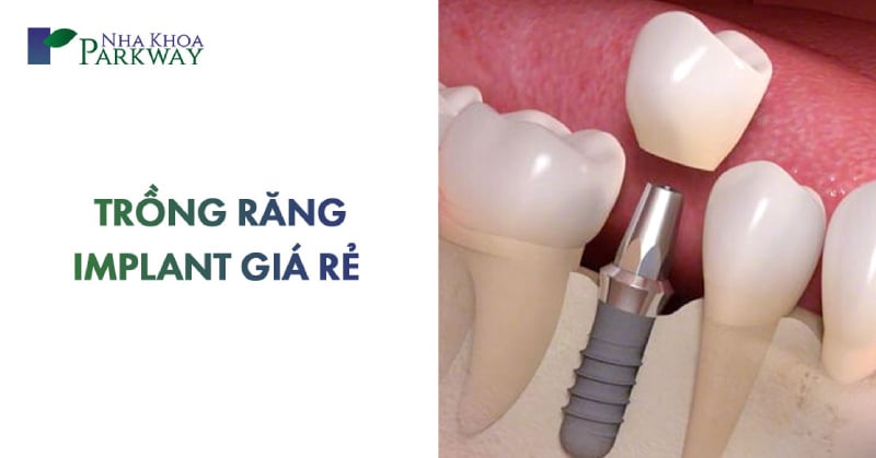 trồng răng implant giá rẻ