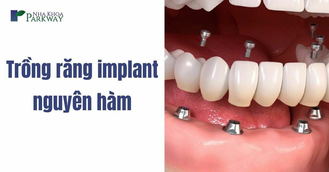 trồng răng implant nguyên hàm