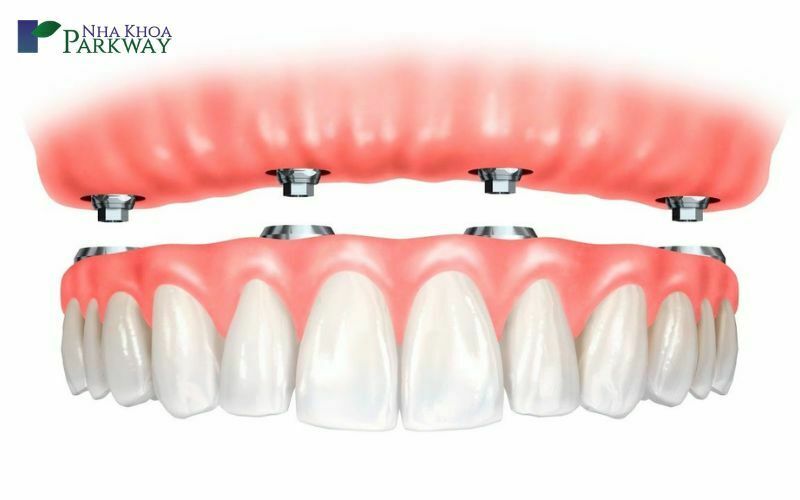 Trồng răng implant nguyên hàm được xem là giải pháp phục hình răng hiệu quả