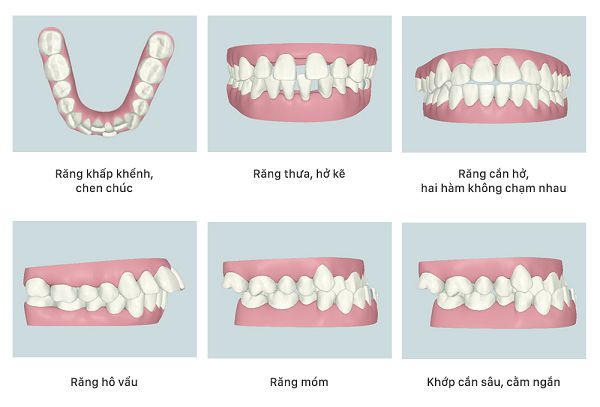 Những trường hợp cần niềng răng