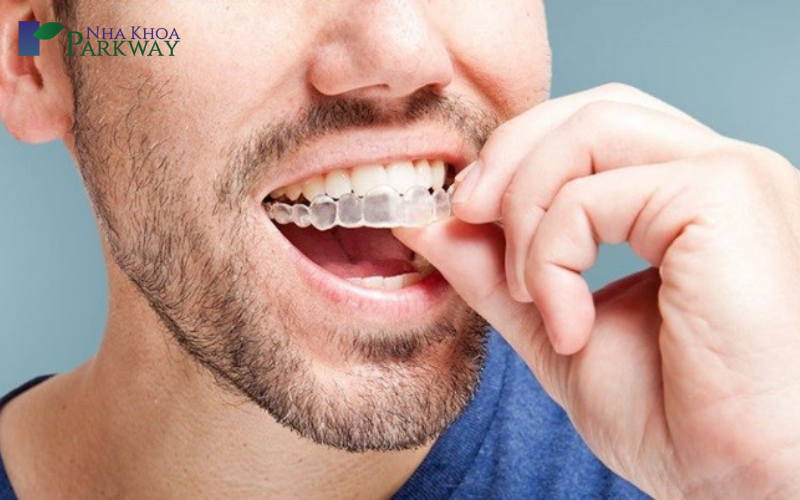 Ưu điểm niềng răng invisalign