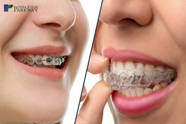 các trường hợp niềng răng trong suốt