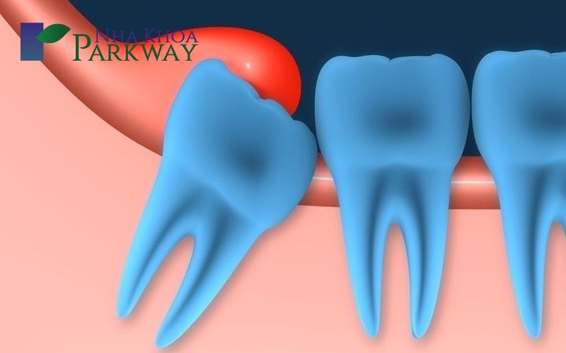 Một vài nguyên nhân gây ra viêm lợi răng hàm